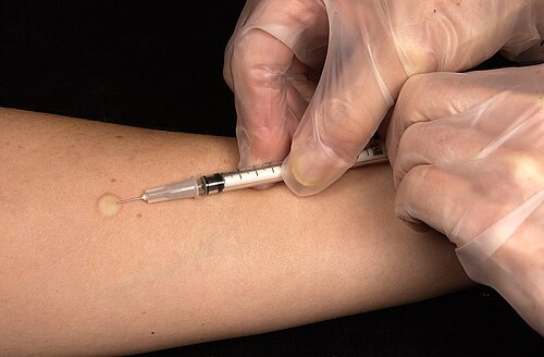 tuberculin skin test